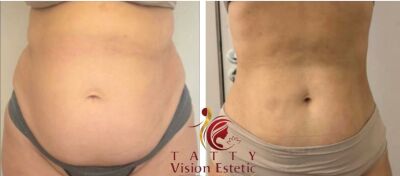 Imagem da notícia Clínica Vision Estética aposta em equipamentos de última geração para transformar o corpo e a autoestima dos pacientes